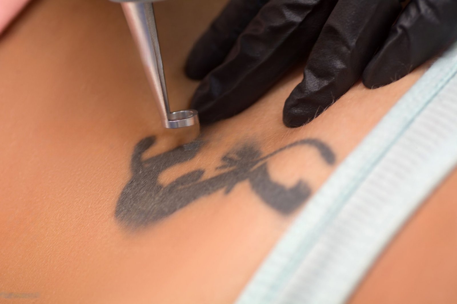 Pico Laser Tattoo Removal: The Complete 2026 Guide to Technology, Benefits, Treatments & Choosing the Right Professional Machine
